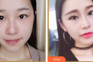 福州眼科醫(yī)院張芳芳整形價(jià)格表附眼部多項(xiàng)案例展示