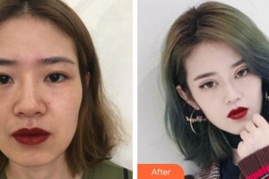 福州眼科醫(yī)院鄭帆整形價(jià)格表附切開(kāi)雙眼皮+倒睫矯正案例展示