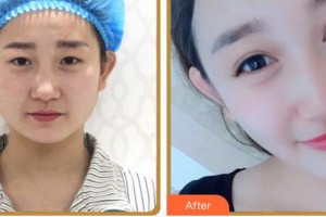 福州眼科醫(yī)院張琳整形價(jià)格表附雙眼皮案例展示