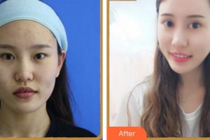 福州眼科醫(yī)院劉默爾整形價(jià)格表附眼部整形案例展示