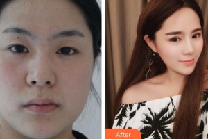 福州眼科醫(yī)院陳迎月整形價(jià)格表附眼部整形案例展示