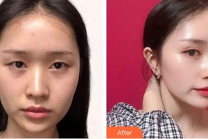 福州東南眼科醫(yī)院李云女整形價(jià)格表附雙眼皮案例展示