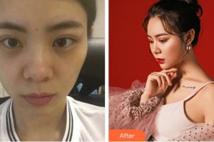 福州東南眼科醫(yī)院吳欽玲整形價(jià)格表附雙眼皮修復(fù)案例展示