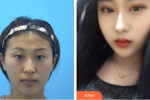 福州東南眼科醫(yī)院曾垂欽整形價(jià)格表附切開(kāi)雙眼皮+開(kāi)眼角案例展示