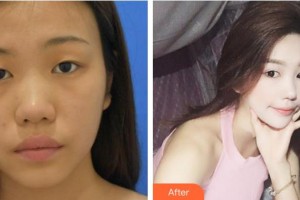 福州東南眼科醫(yī)院胡敏芝整形價格表附眼部手術案例展示