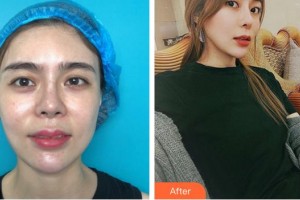 福州東南眼科醫(yī)院洪我象整形價格表附我的整形經(jīng)歷案例展示