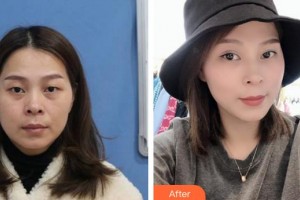 福州東南眼科醫(yī)院高文星整形價格表附上瞼微整案例展示