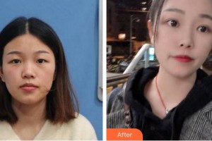 福州東南眼科醫(yī)院魏金鑫整形價格表附雙眼皮案例展示