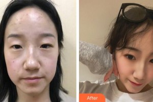 福州東南眼科醫(yī)院歐麗萍整形價(jià)格表附雙眼皮案例展示