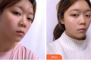 福州東南眼科醫(yī)院王燕蘭整形價格表附雙眼皮案例展示