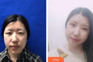 福州東南眼科醫(yī)院朱銳整形價格表附美眼案例展示