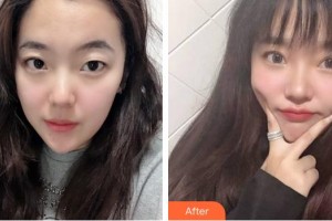 福州東南眼科醫(yī)院李仲整形價格表附雙眼皮案例展示