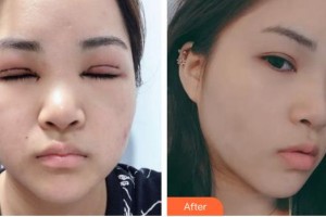 福州東南眼科醫(yī)院趙曉春整形價(jià)格表附眼部整形案例展示