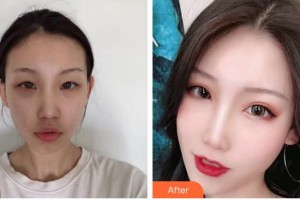 福州東南眼科醫(yī)院郭穎整形價(jià)格表附雙眼皮案例展示