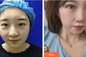 福州東南眼科醫(yī)院鄭文整形價(jià)格表附雙眼皮案例展示