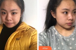 福州東南眼科醫(yī)院林寶仁整形價(jià)格表附眼部案例展示