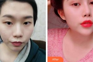 福州東南眼科醫(yī)院鄭建亮整形價(jià)格表附切開(kāi)雙眼皮案例展示