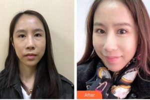 福州東南眼科醫(yī)院林興中整形價(jià)格表附不開(kāi)刀去眼袋+淚溝填充+收緊案例展示