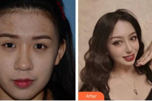 福州東南眼科醫(yī)院程潔整形價(jià)格表附切開(kāi)雙眼皮案例展示