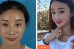 福州東南眼科醫(yī)院莊淑流整形價(jià)格表附雙眼皮案例展示