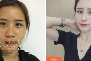福州東南眼科醫(yī)院陳元整形價格表附眼部手術(shù)、鼻部手術(shù)，多方面部脂肪填充案例展示