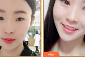 福州東南眼科醫(yī)院劉秀珍整形價格表附眼部修復(fù)案例展示