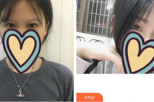 福州東南眼科醫(yī)院于麟整形價格表附get新技能較強眼妝眼部手術(shù)案例展示