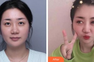 福州東南眼科醫(yī)院程天書整形價格表附眼部整形案例展示