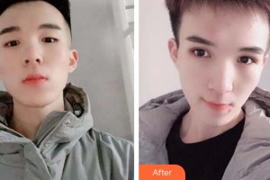 福州東南眼科醫(yī)院謝建明整形價格表附5s重瞼術(shù)+超微創(chuàng)開內(nèi)眥案例展示