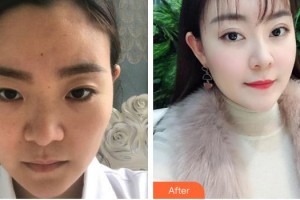 福州東南眼科醫(yī)院謝威義整形價格表附眼部手術(shù)案例展示