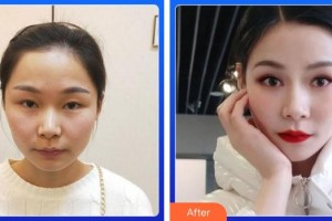 福州東南眼科醫(yī)院肖國武整形價格表附5s重瞼術(shù)+超微創(chuàng)開內(nèi)眥案例展示