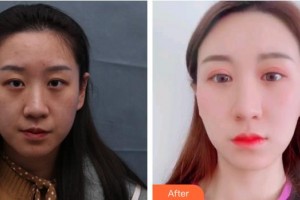 福州東南眼科醫(yī)院吳國瑋整形價格表附埋線重瞼修復(fù)+內(nèi)眥開大術(shù)案例展示