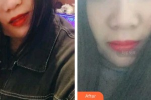 福州三顆牙口腔門診部鐘韋韋整形價格表附超聲波潔牙案例展示