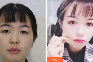 福州東南眼科醫(yī)院鄭總整形價(jià)格表附切開(kāi)雙眼皮 靈動(dòng)微創(chuàng)案例展示