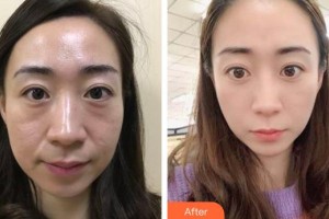 福州東南眼科醫(yī)院陳波整形價格表附切開雙眼皮案例展示