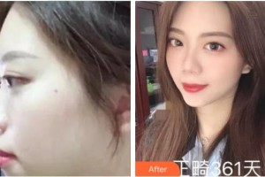 福州三顆牙口腔門診部許積紅整形價(jià)格表附骨性齙牙妹氣質(zhì)UPUPUP案例展示