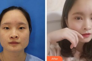 福州東南眼科醫(yī)院周成銀整形價格表附全切雙眼皮案例展示