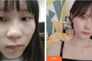 福州東南眼科醫(yī)院陳建明整形價(jià)格表附眼部整形案例展示