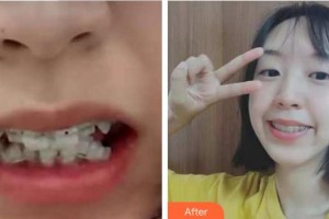 福州東南口腔醫(yī)院李明考整形價(jià)格表附牙齒矯正案例展示