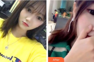 福州弗麗嘉口腔門診部楊奇志整形價(jià)格表附超聲波潔牙案例展示