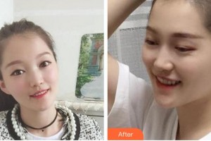 福州科爾口腔門診部劉斌元整形價(jià)格表附金屬托槽矯正案例展示