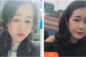 福州東南眼科醫(yī)院陳克平整形價(jià)格表附切開(kāi)雙眼皮案例展示