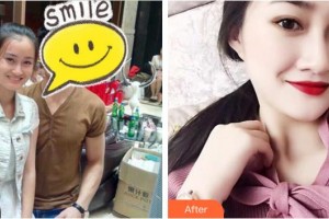 福州東南眼科醫(yī)院張智勇整形價(jià)格表附做雙眼皮真的是超棒的投資案例展示