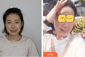 福州同福醫(yī)口腔門診部何鐘強(qiáng)整形價(jià)格表附瓷貼面日記案例展示