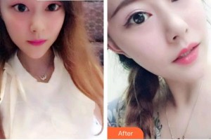 福州美可普口腔門診部武岳整形價(jià)格表附牙齒瓷貼面案例展示