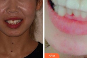 福州同福醫(yī)口腔門診部洪容燕整形價(jià)格表附隱形矯正案例展示