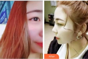 福州維樂(lè)口腔門診部許長(zhǎng)記整形價(jià)格表附超聲波潔牙案例展示