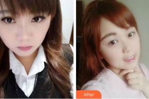 福州美可普口腔門診部劉杰整形價格表附牙齒隱形矯正案例展示