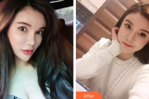 福州愛尚貝臣口腔門診部羅維明整形價格表附超聲波潔牙案例展示