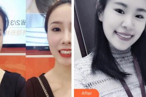 福州愛尚貝臣口腔門診部郭偉忠整形價格表附牙齒隱形矯正案例展示